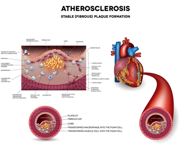 Aterosclerosis. Formación de placa fibrosa en la arteria — Archivo Imágenes Vectoriales