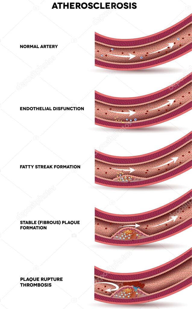 Atherosclerosis. Detailed illustration of Atherosclerosis stages