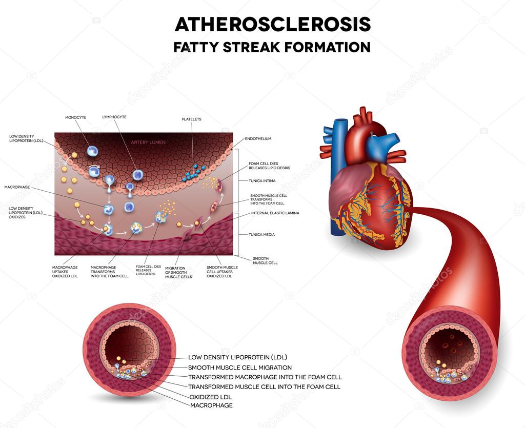 Atherosclerosis. Early stage