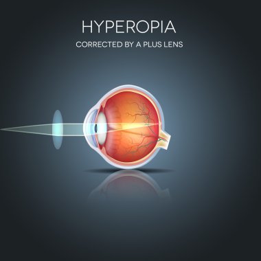 Hipermetropi artı bir lens tarafından düzeltildi