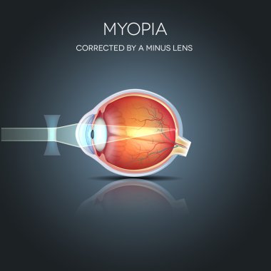 Eksi bir lens tarafından düzeltildi miyopi