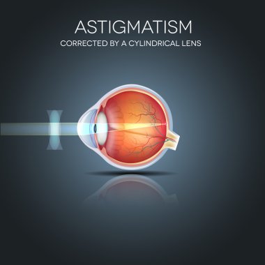 Astigmat silindirik bir lens tarafından düzeltildi.