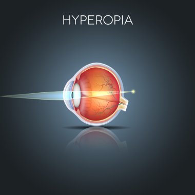 Hyperopia clipart