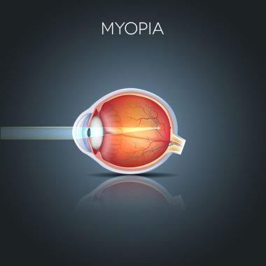 Myopia clipart
