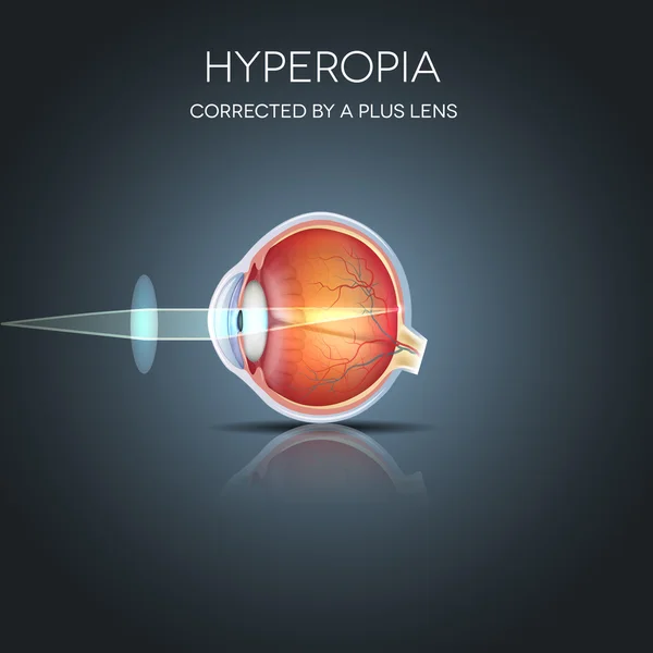 Hyperopia corrected by a plus lens — Stock Vector