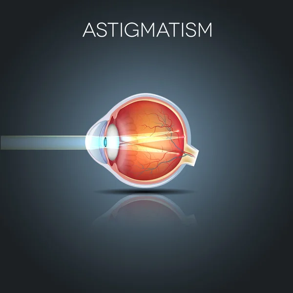 Astigmatismo — Archivo Imágenes Vectoriales