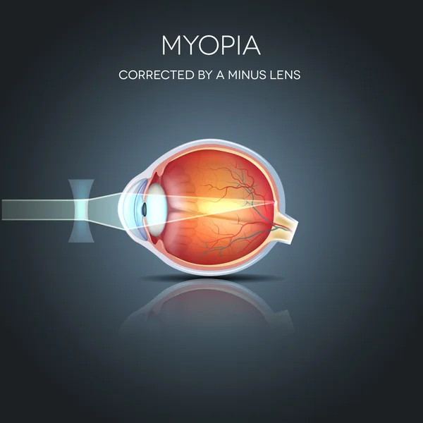 Myopia corrected by a minus lens — Stock Vector