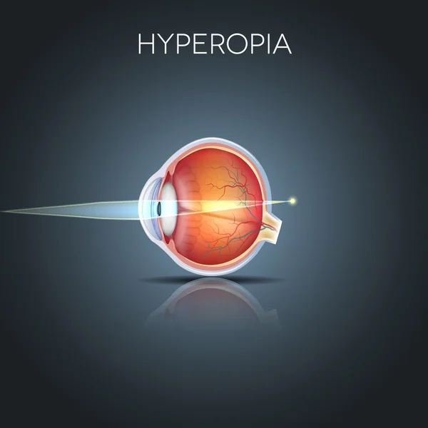 Hiperopia - Stok Vektor