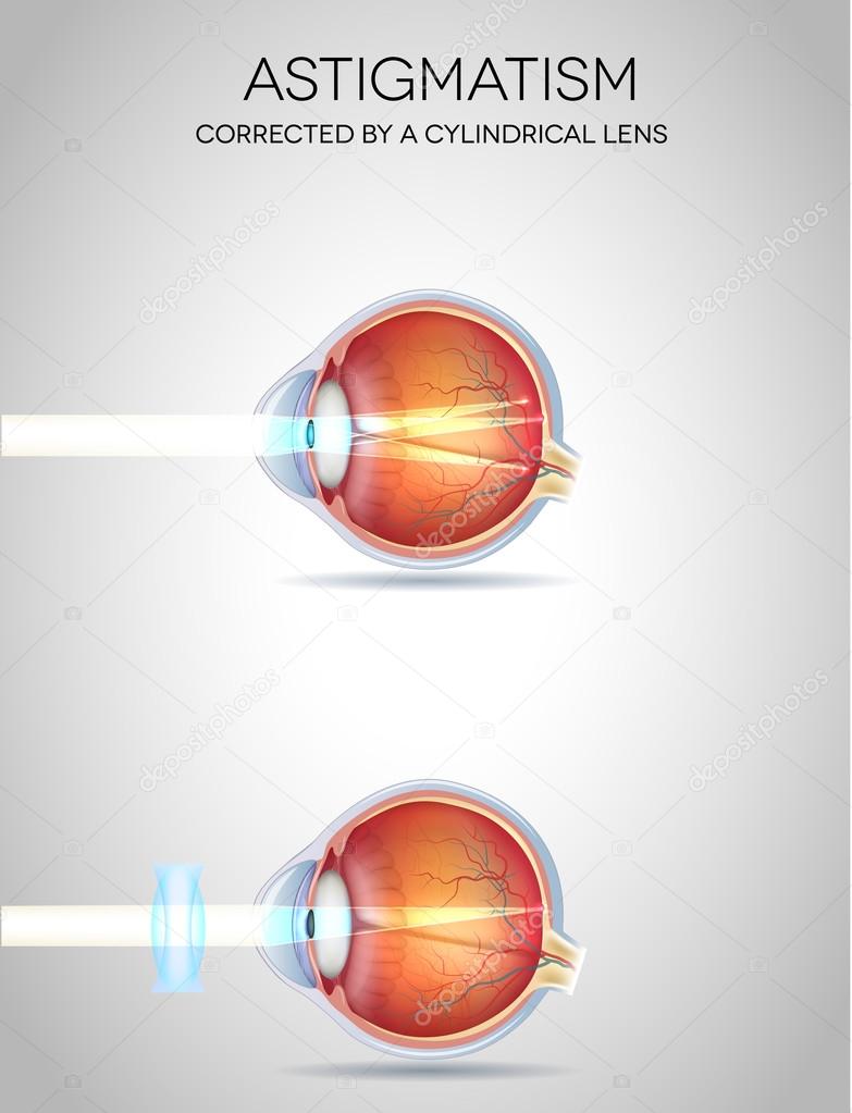 Eye vision disorders