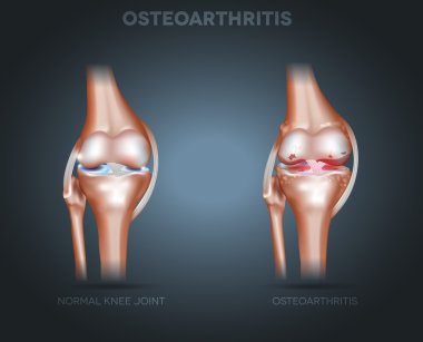 Osteoarthritis and normal joint anatomy clipart