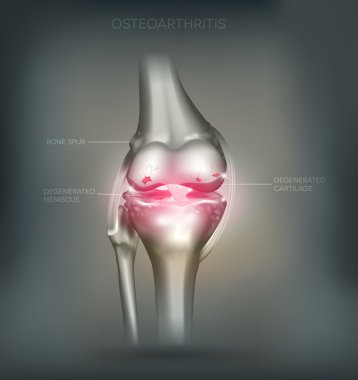 Osteoartrit diz eklem yıkımı