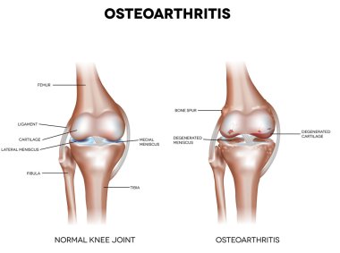Knee Osteoarthritis clipart