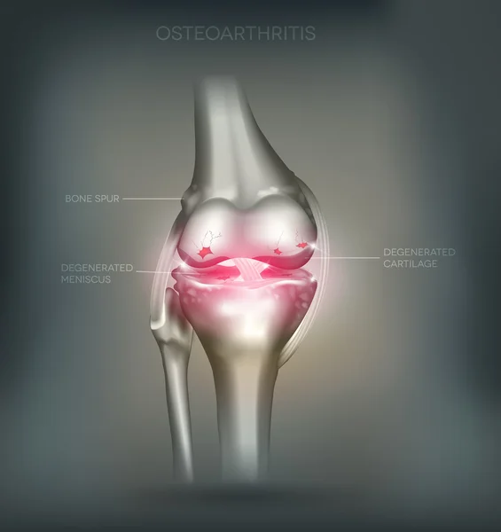 Osteoartrite destruição da articulação do joelho —  Vetores de Stock