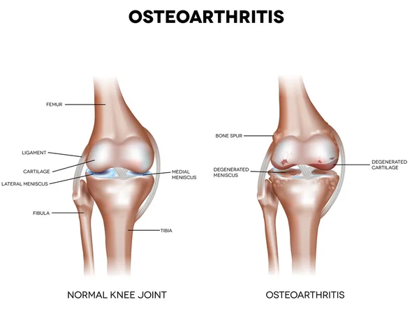 A térd Osteoarthritis — Stock Vector