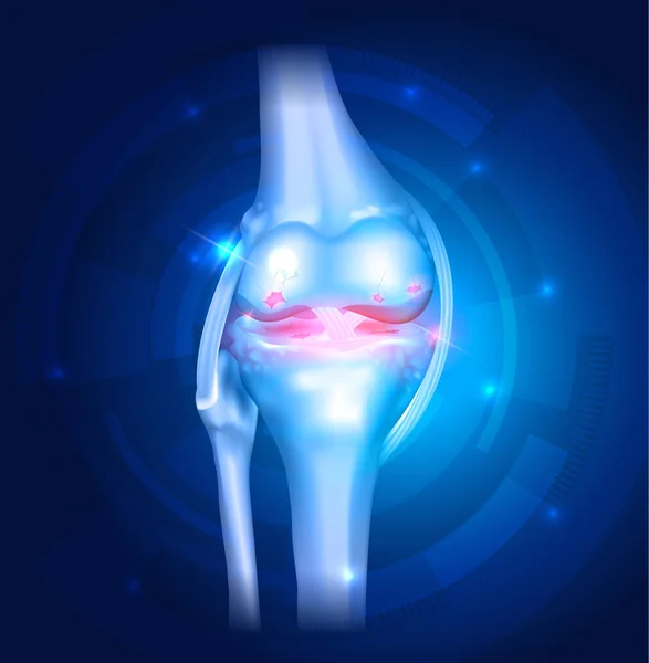 Hintergrund Knie-Arthrose — Stockvektor