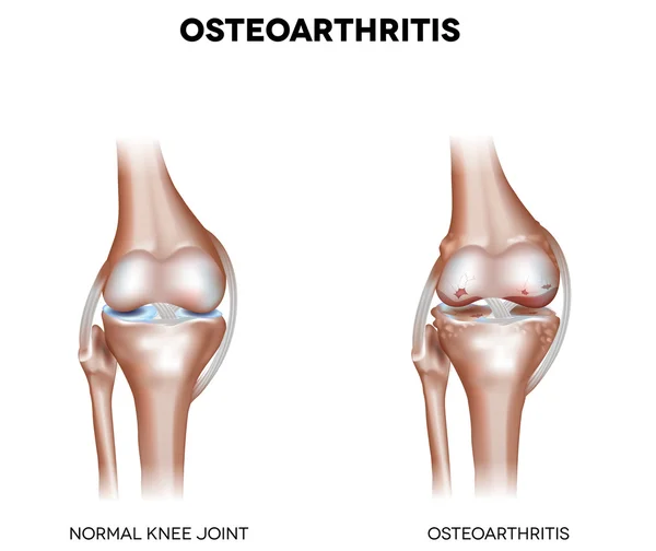 Knee Osteoarthritis — Stock Vector