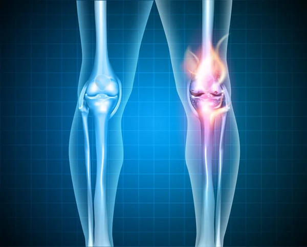 Burning knee — Stock Vector