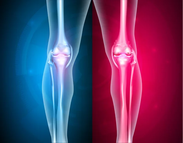 Articulações do joelho saudáveis e insalubres — Vetor de Stock