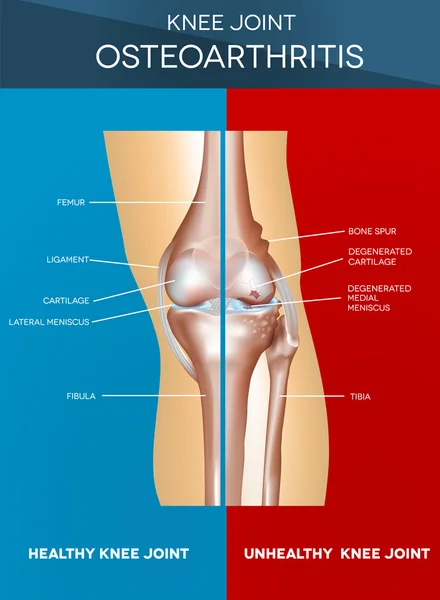 骨关节炎和正常关节 — 图库矢量图片