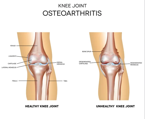 Osteoartrite e articulação normal — Vetor de Stock