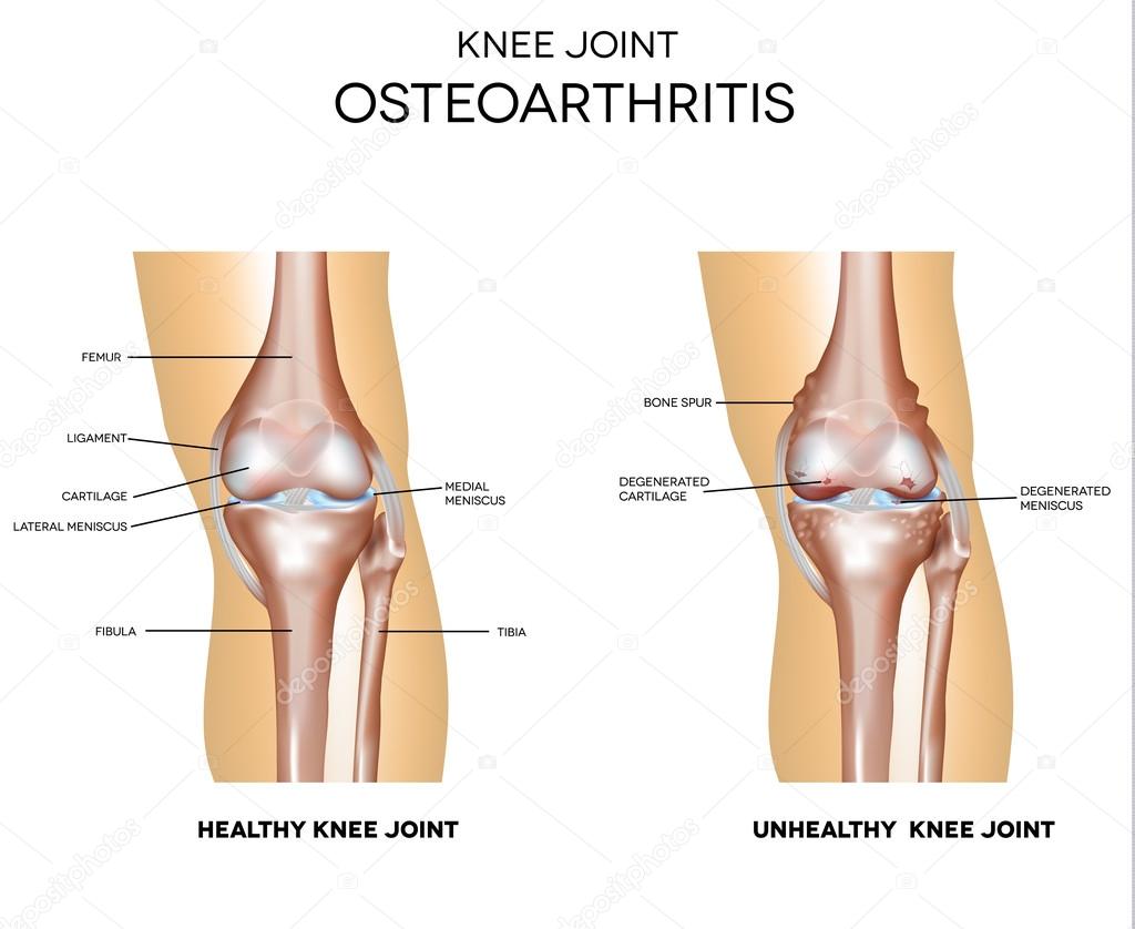 Osteoarthritis and normal joint 