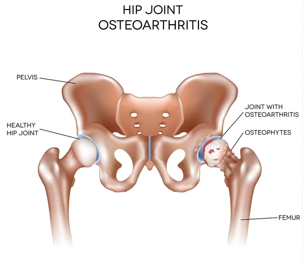 Arthritis of the hip joint — Stock Vector