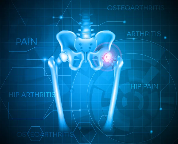 Arthritis of the hip joint — Stock Vector