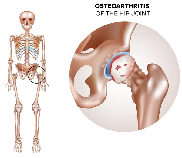 Artritis de cadera — Vector de stock