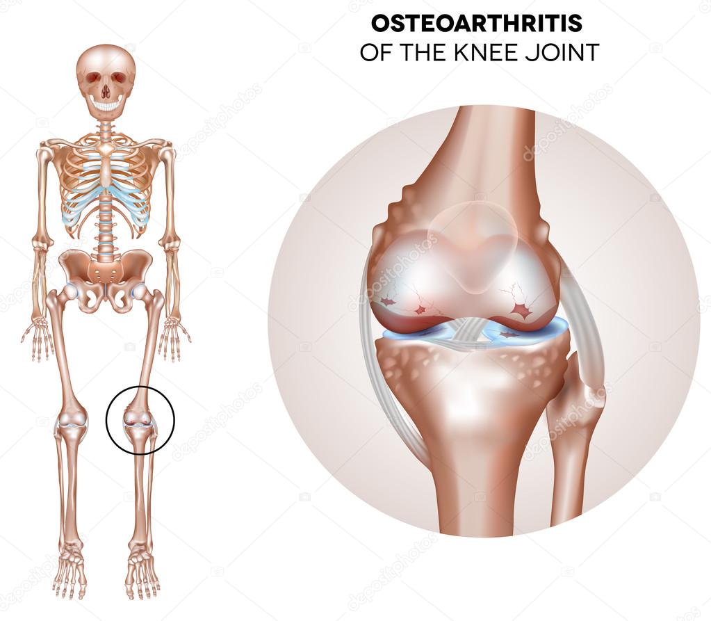 Arthritis of the knee joint