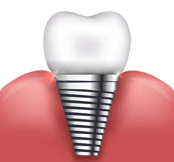 Dental implant — Stockvector