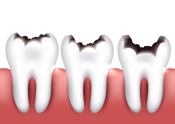Carie dentale — Vettoriale Stock