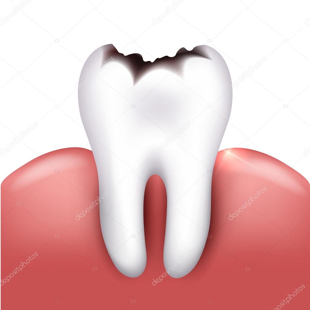 Tooth with caries