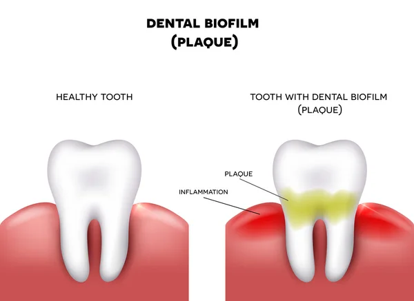 Placa dental — Archivo Imágenes Vectoriales