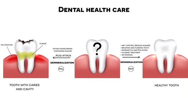 Cuidados de saúde dentária, dente saudável e dente com cárie — Vetor de Stock