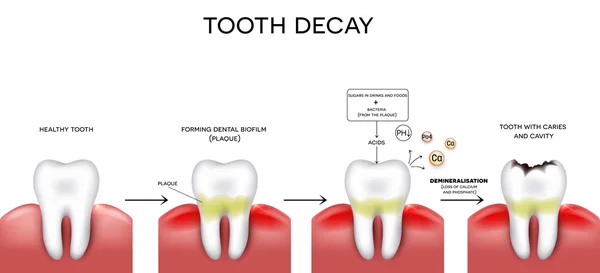 Formation de carie dentaire — Image vectorielle