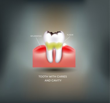 Diş çürüğü ve boşluğu