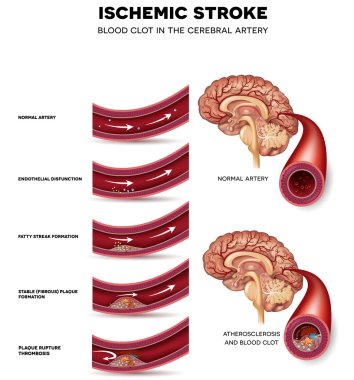 Blood clot formation in the cerebral artery clipart