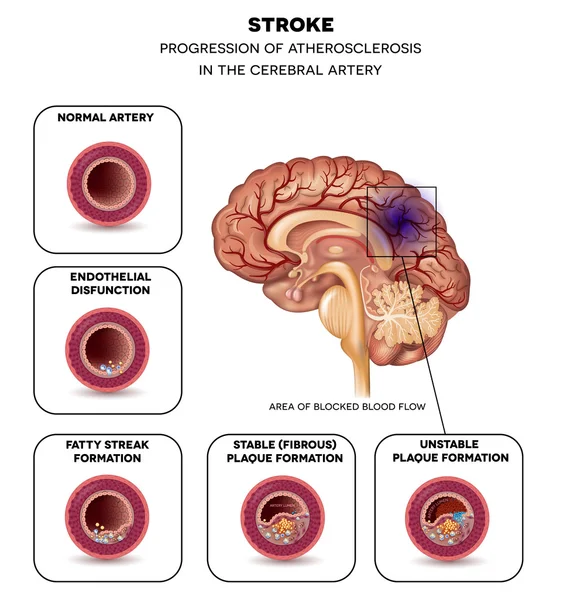 Stroke in the brain artery — Stock Vector