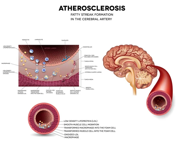 Атеросклероз. Жирная полоса образования в мозгу — стоковый вектор