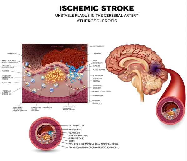 Formación inestable de placa y trombo — Archivo Imágenes Vectoriales