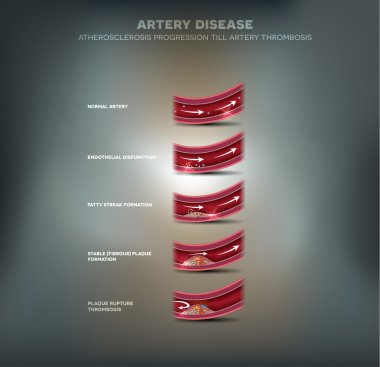 Arter hastalığı, ateroskleroz ilerleme ve kan pıhtısı
