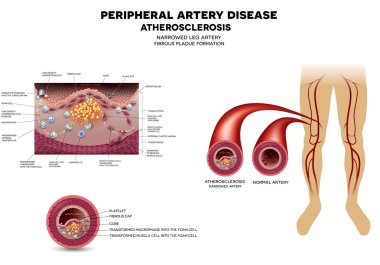 Leg artery disease, Atherosclerosis clipart
