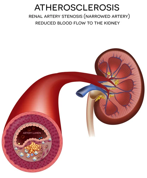 Renal artery disease. Atherosclerosis — Stock Vector