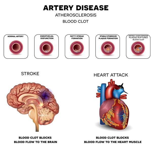 Enfermedad arterial, aterosclerosis, accidente cerebrovascular y ataque cardíaco — Archivo Imágenes Vectoriales