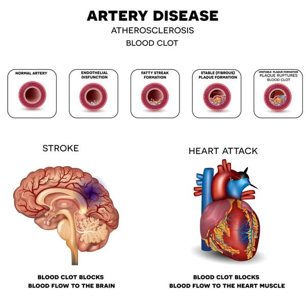 Slagader ziekte, atherosclerose, beroerte en Heart attack Stockvector