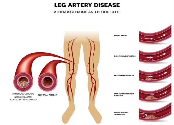 Хвороба артерій ніг, атеросклероз Стокова Ілюстрація