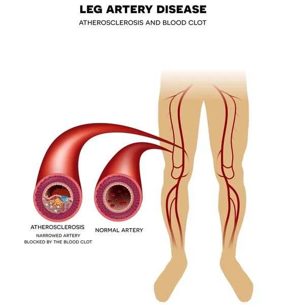 Хвороба артерій ніг, атеросклероз Ліцензійні Стокові Вектори