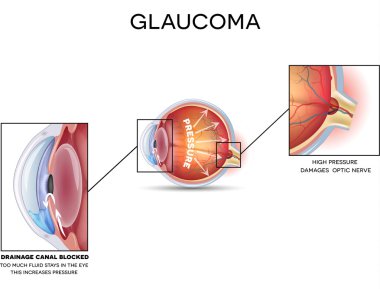 glakom