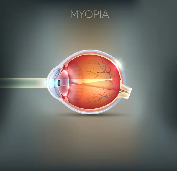 Myopi, vision sjukdom — Stock vektor