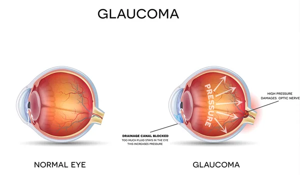 Глаукома — стоковий вектор